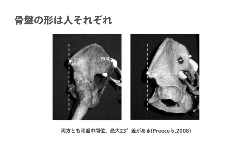 骨盤の形のは大きな違い