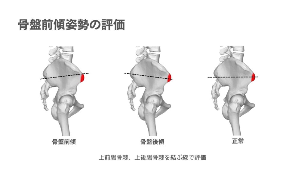 骨盤前傾